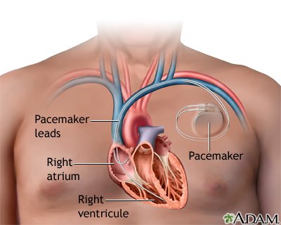 What connectors and interconnects are used in pacemakers and ICDs?